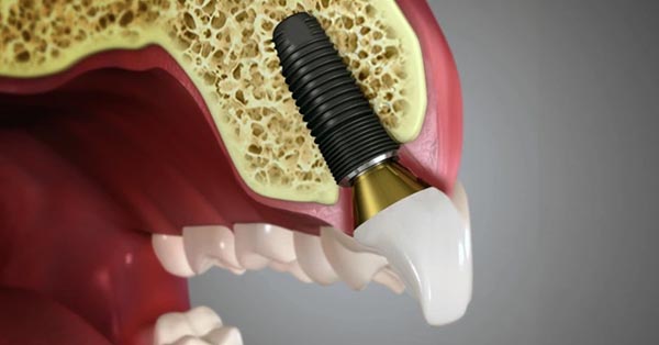 Straight Teeth Are Healthy Teeth: Why Alignment Matters