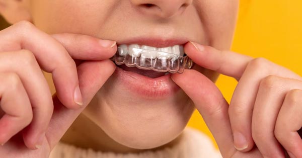 Tips for the Care of Invisalign Trays - Perkins Dental Care Baltimore  Maryland